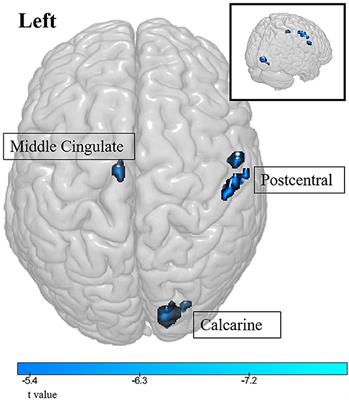 Preoperative early-stage lung cancer patients and local brain area changes: a cross-sectional observational descriptive study